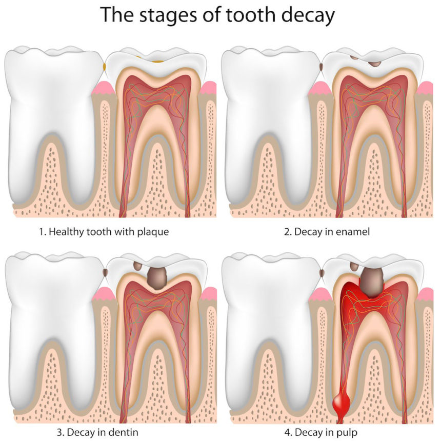 Cavities