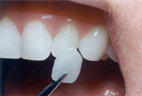 Dental Veneers